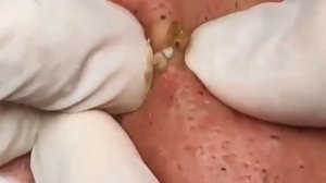 粉刺 粟粒腫 Сдавить прыщи Черные точки Dermatologist video to press pimples Тебя стошнит от этого видео