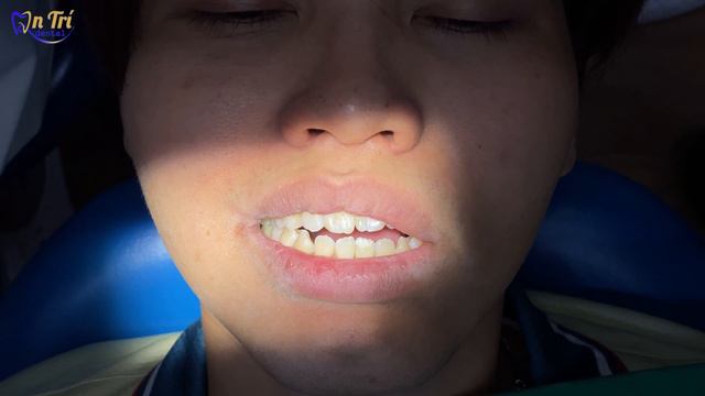 Quá trình gắn hòan thiện răng sứ trên Implant #nhakhoaantri #drtrinhquangtri #implants #trongimplan смотреть онлайн