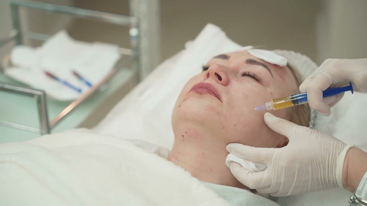 Плазмотерапия Cortexil PRP смотреть онлайн