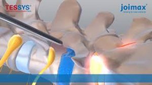 Эндоскопическое удаление грыжи межпозвонкового диска.