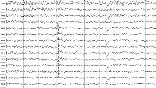Пример нормальной ЭЭГ: как оценивать и что писать смотреть онлайн