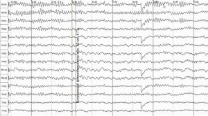 Пример нормальной ЭЭГ: как оценивать и что писать