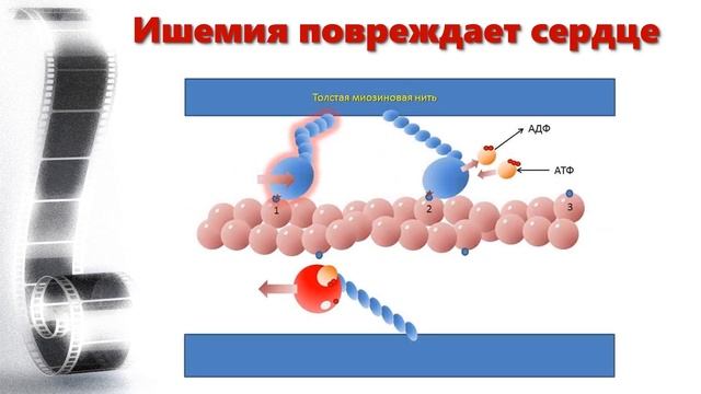 Ишемия миокарда