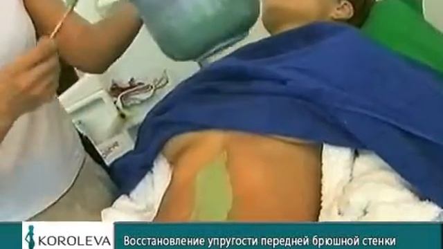 Восстановление упругости передней брюшной стенки смотреть онлайн