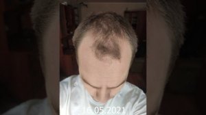 Миноксидил - результат через год. 10 месяцев использования. Да или нет?