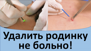 Удалить родинку не больно!