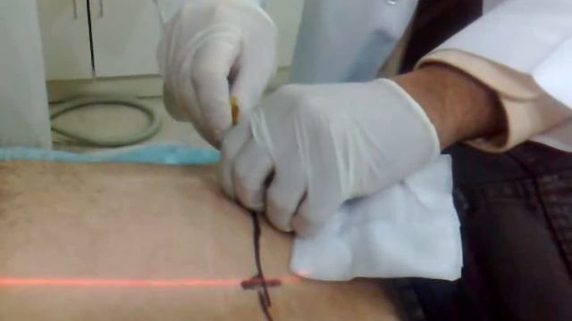 Retroperitoneal lymph node, Diffuse large B-cell lymphoma.wmv смотреть онлайн