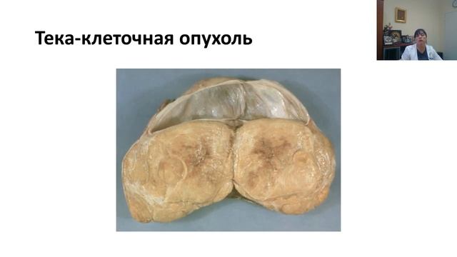 Опухоли яичника.mp4