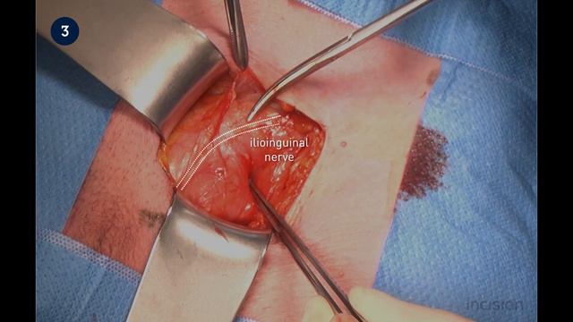 Open Inguinal Hernia Repair (Lichtenstein) - Indirect Hernia