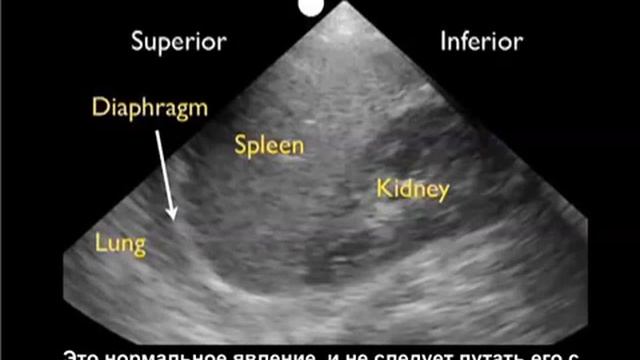 Trauma.ru Гидроторакс на УЗИ. смотреть онлайн
