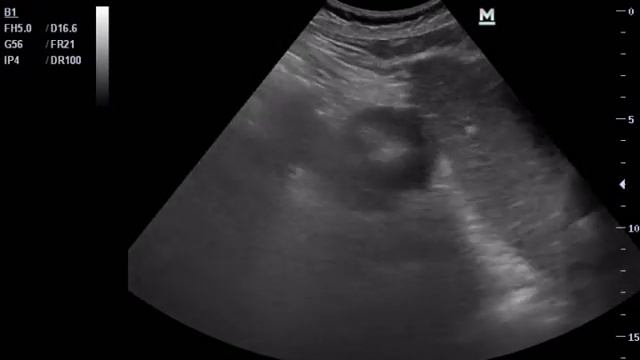 Рак желудка смотреть онлайн