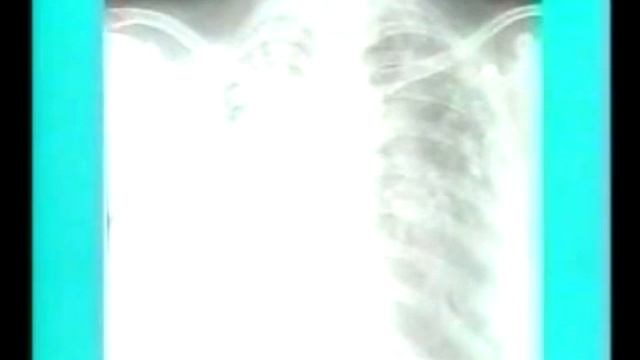 2.1.8. Calcified Lesions - Chest X-Rays - Dr. Vaidya смотреть онлайн