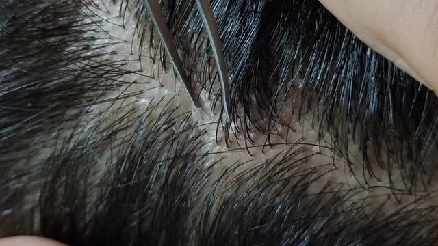 Relaxing Dandruff Removal (w/ Tweezers) #15 02sleepyheads | Visual ASMR #oddlysatisfying