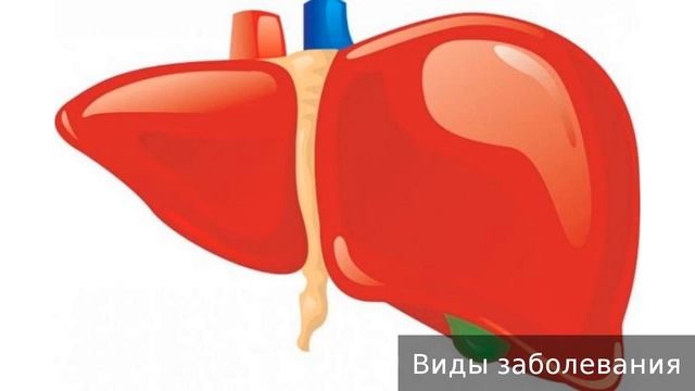 Гепатомегалия. Как лечить гепатомегалию. смотреть онлайн