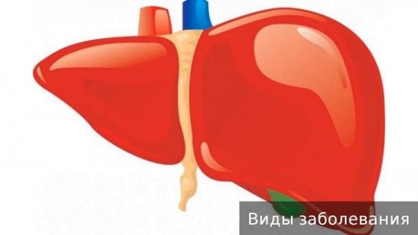 Гепатомегалия. Как лечить гепатомегалию.