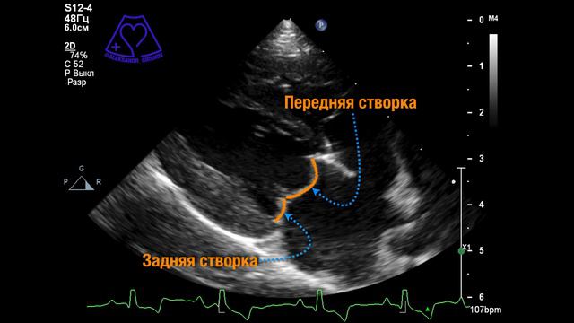 Пролапс Митрального Клапана смотреть онлайн