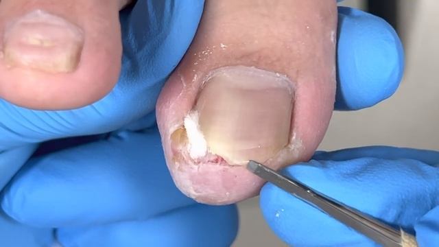 Solve the problem of ingrown nails and heal quickly【Xue Yidao】 смотреть онлайн