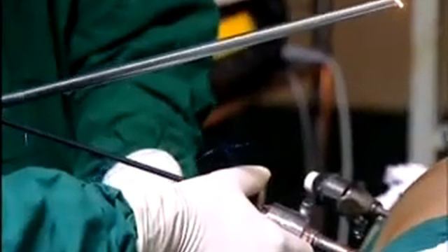 LAPAROSCOPIC UMBILICAL HERNIA REPAIR VIDEOS смотреть онлайн