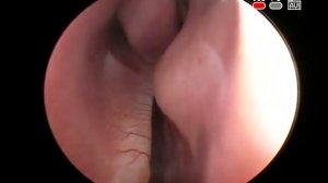 Эндоскопия полости носа: искривление перегородки носа