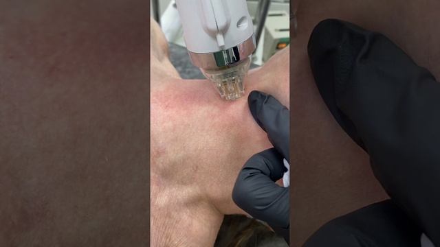 Семинар «Микроигольчатый РФ-лифтинг» смотреть онлайн