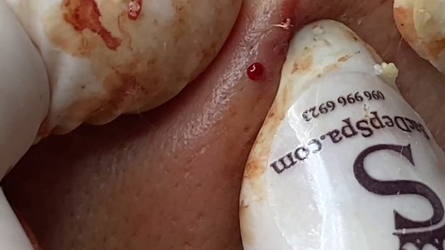 Acne Treatment For "Hung" (P6) | Điều Trị Mụn Cho Hùng (P6) = SacDepSpa#193 смотреть онлайн