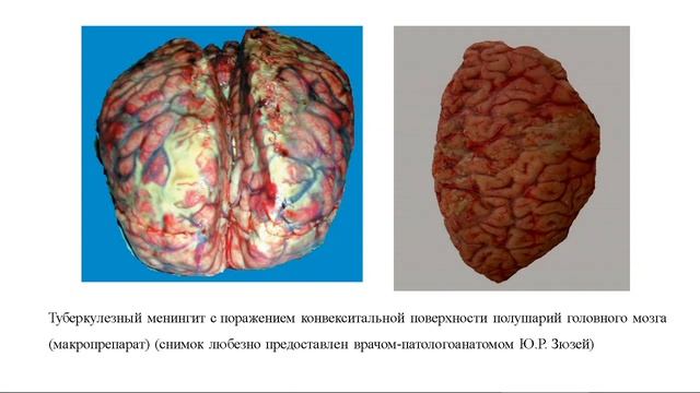 Туберкулезный менингит у лиц с различным ВИЧ-статусом смотреть онлайн
