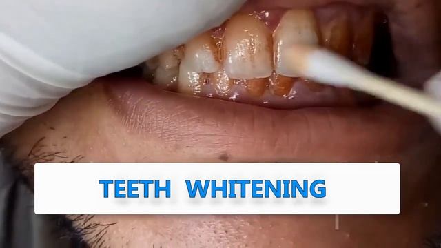 LANBENA TEETH WHITENING ESSENCE 1 смотреть онлайн