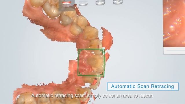 Aoralscan Intraoral Scanner - SHINING 3D Digital Dental Solutions смотреть онлайн