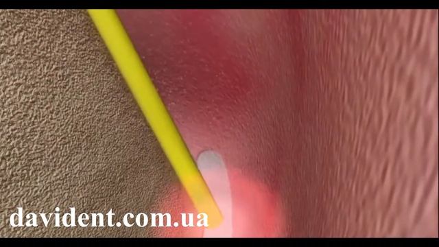 Лазерная стоматология смотреть онлайн