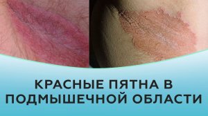 Красные пятна в подмышечной области.