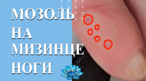Сухая мозоль на пальце ноги. Как избавиться.