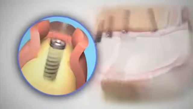 Полный съемный протез MIS смотреть онлайн