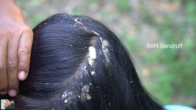 Psoriasis treatment - Huge Flakes, Dandruff Scratching #134 смотреть онлайн