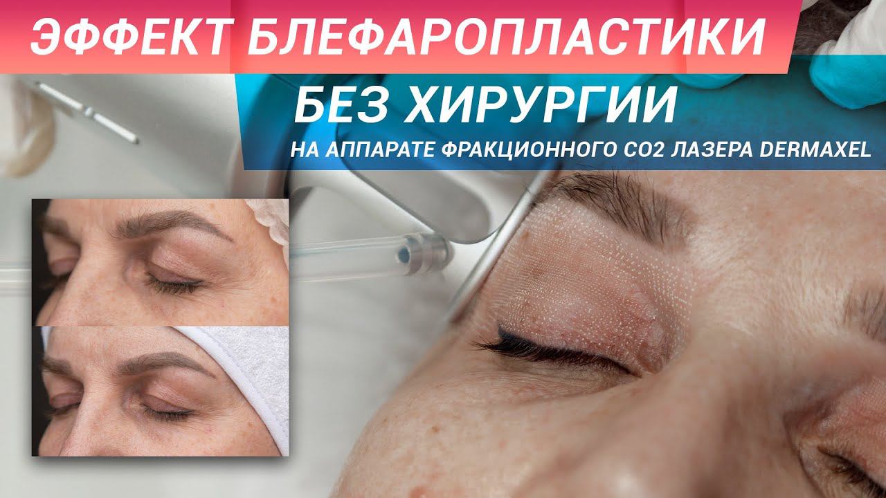 Лазерное омоложение век с эффектом блефаропластики за одну процедуру смотреть онлайн