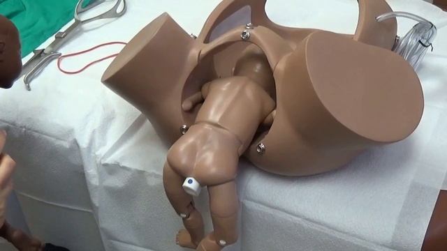 Breech Delivery - A Systematic Approach смотреть онлайн