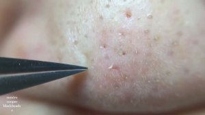 Удаление пинцетом черных точек на носу