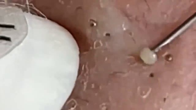 удаление черных точек #823