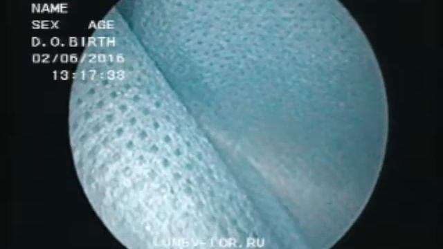 Микрогайморотомия удаление кисты верхнечелюстной пазухи 02062016 смотреть онлайн