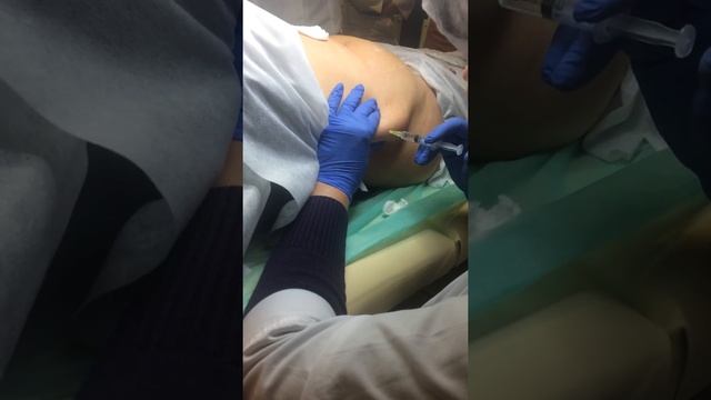 Мезотерапия и Биоревитализация. Мезотерапия тела. Практика