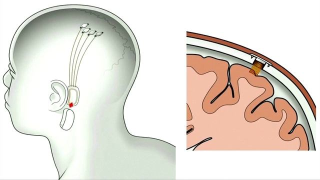 Мозговой имплантат Neuralink Илона Маска