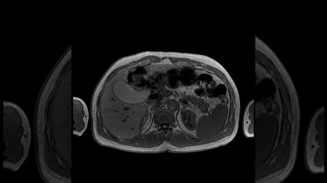 HBP C5 MRI MRCP (C) смотреть онлайн