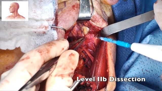 Level II-IV Select Neck Dissection смотреть онлайн