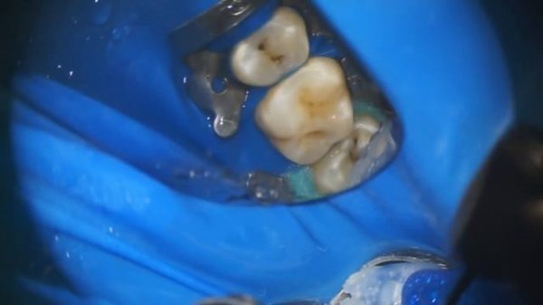 Лечение кариеса под микроскопом [caries treatment under microscope]