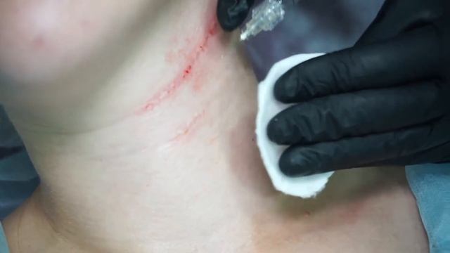 Бланшинг колец Венеры