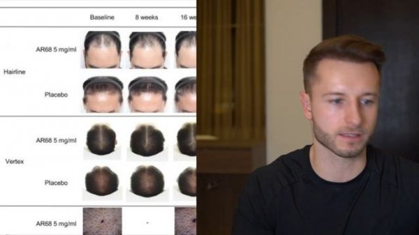 CosmeRNA NEW HAIR LOSS TREATMENT in the pipelines! mRNA based Anti Androgen