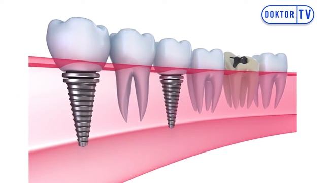 DİŞ İMPLANTI BAKIMI NASIL YAPILMALI ? смотреть онлайн