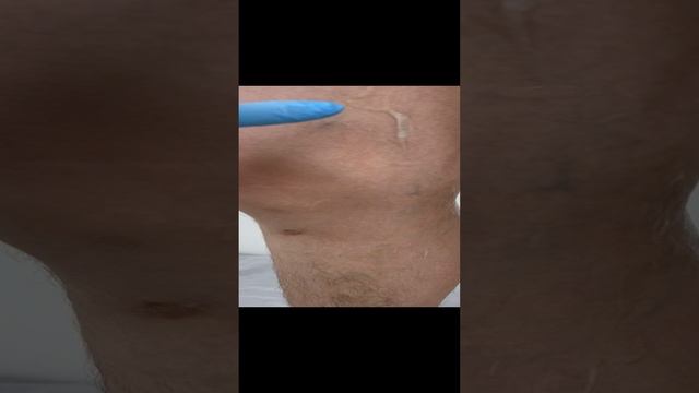 Нетипичная Вена. Варикоз лечение. Интересный случай. Флеболог Москва. Флеболог. Сосудистый хирург. смотреть онлайн