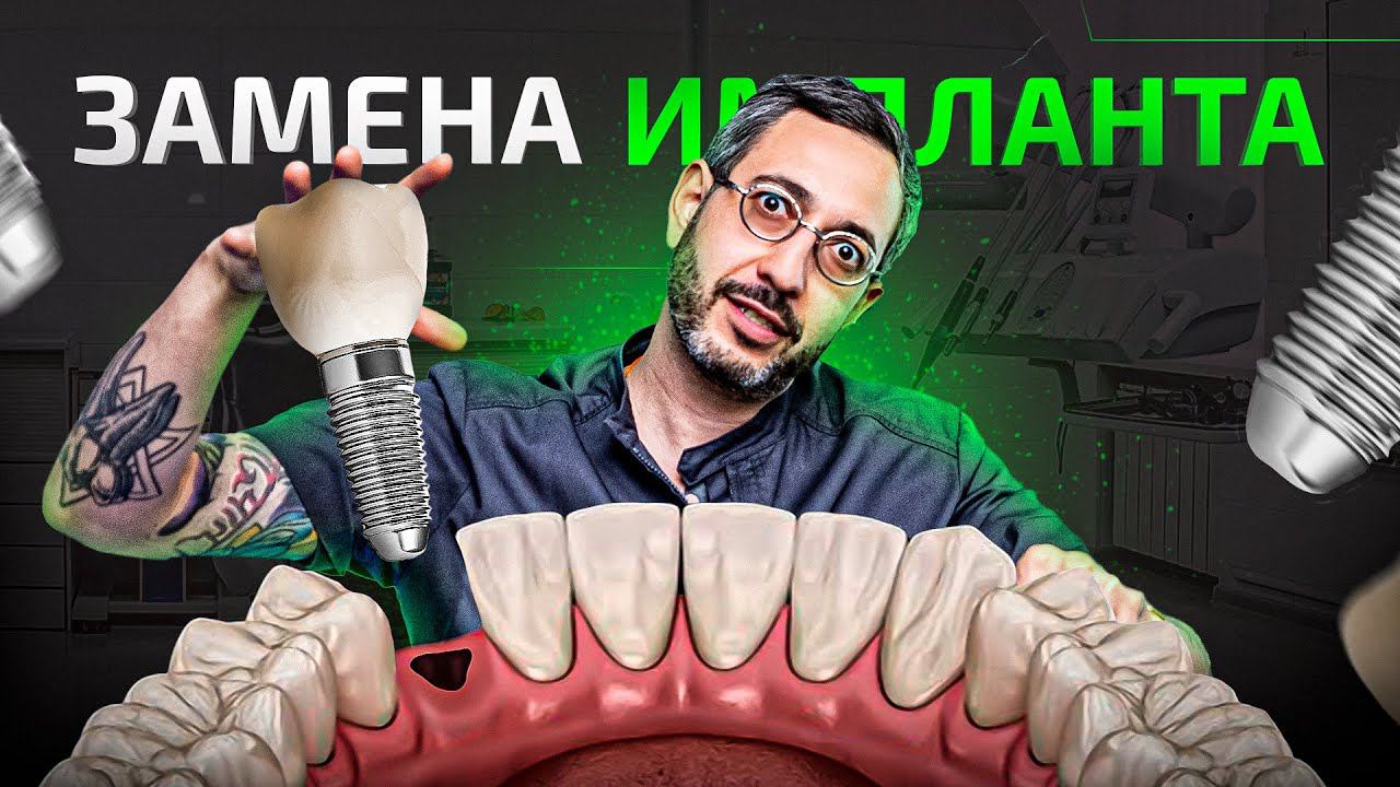 Удаление зуба — удаление старых и постановка новых имплантатов | LIVE