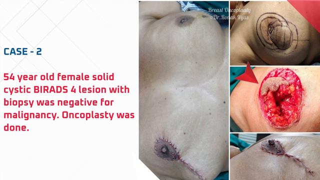 𝐂𝐚𝐬𝐞𝐬 𝐨𝐟 𝐛𝐫𝐞𝐚𝐬𝐭 𝐎𝐧𝐜𝐨𝐩𝐥𝐚𝐬𝐭𝐲 𝐟𝐨𝐫 𝐞𝐚𝐫𝐥𝐲 𝐛𝐫𝐞𝐚𝐬𝐭 𝐜𝐚𝐧𝐜𝐞𝐫 смотреть онлайн