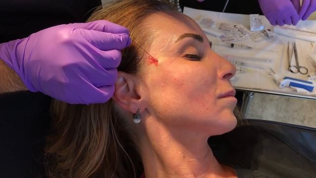 Polydioxanone Thread Lifting Technique смотреть онлайн